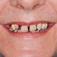 Smile In A Day - Smile 26 before
